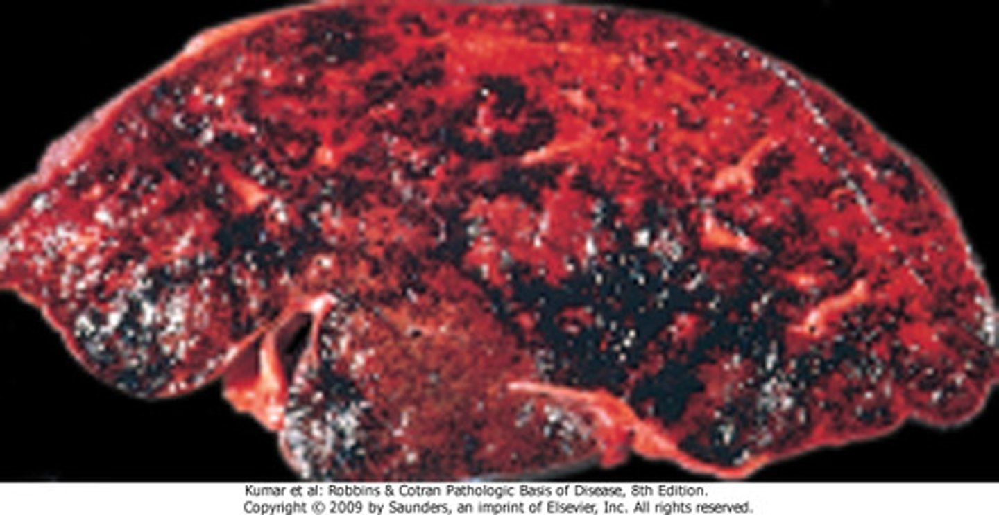 <p>A pregnant patient presents with painful hepatomegaly, ascites, and RUQ pain. She is a smoker, takes OCPs even though they clearly didn't work, and also has polycythemia vera. Life is tough for her. What is the diagnosis? What would you expect on liver biopsy?</p>