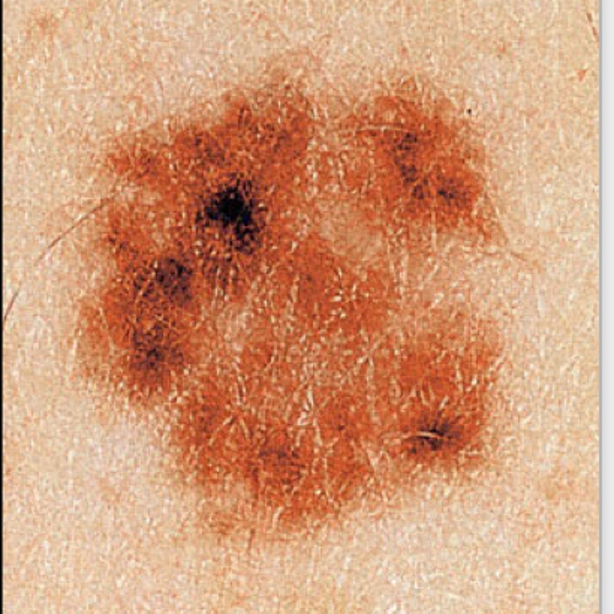 <p>Dysplastic mole </p><p>Not cancer, but has a greater potential to evolve to melanoma </p><p>Located anywhere </p><p>Surgical excision recommended </p>