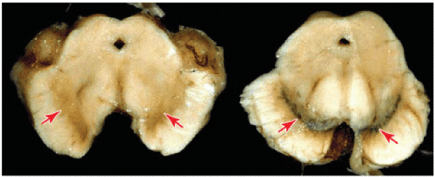 <p>c. Parkinson's disease</p>