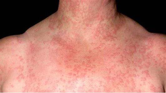 <p>contact with water → eruption similar to cholinergic urticaria</p>