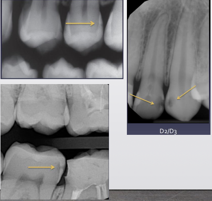<ul><li><p><span style="color: #000000">Once lesion reaches DEJ, demineralization spreads across the interface</span></p></li><li><p><span style="color: #000000">Second triangle forms with broad base at DEJ</span></p><ul><li><p><span style="color: #000000">Dentin triangle has a wider base than enamel</span></p></li></ul></li><li><p><span style="color: #000000">Lesion progresses through dentinal tubules toward pulp</span></p><ul><li><p><span style="color: #000000">Triangular shape may be lost as lesion gets bigger due to curvilinear or “S-shaped” arrangement of dentin tubules</span></p></li></ul></li></ul><p></p>