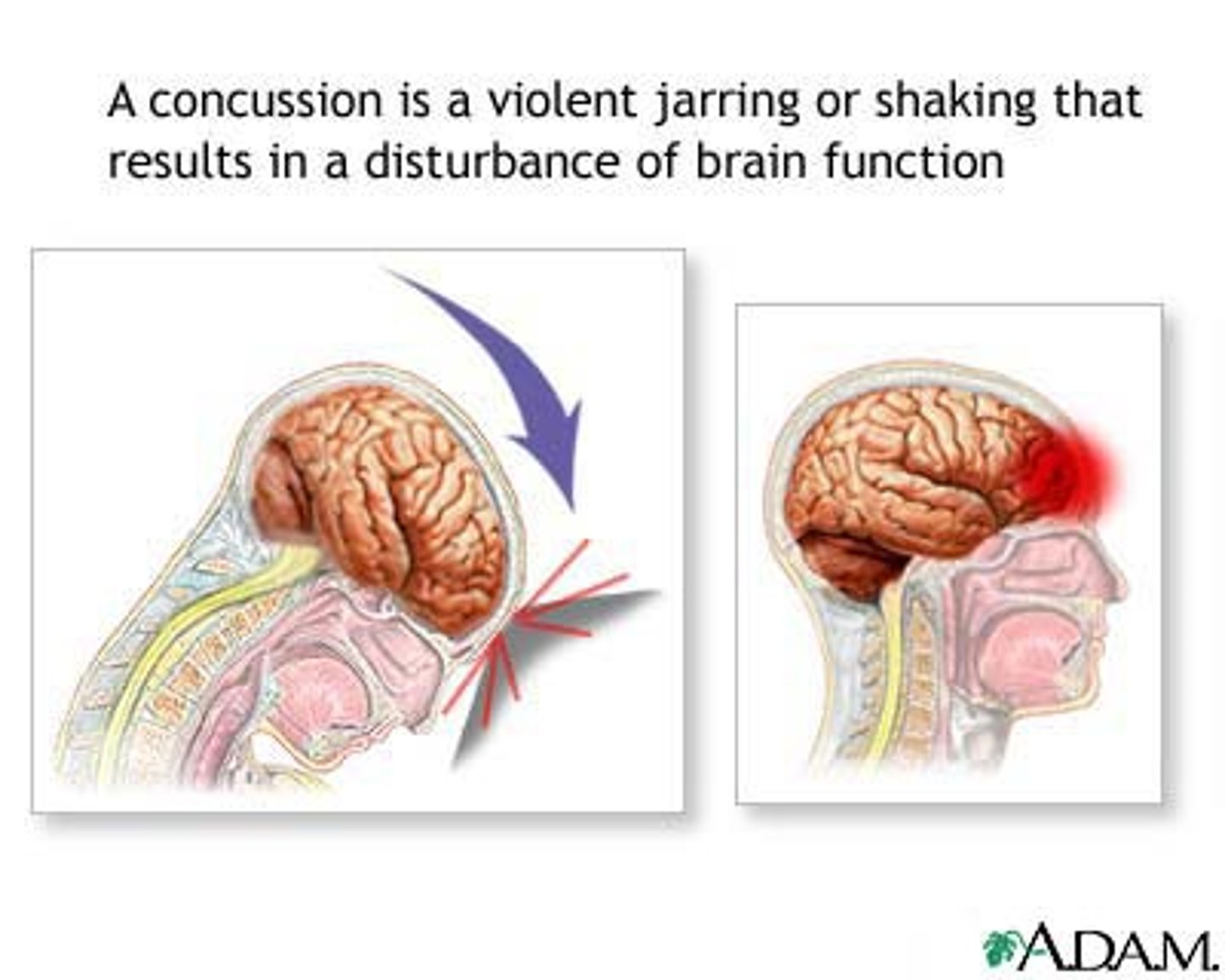 <p>A violent shaking up or jarring of the brain may result in a temporary loss of awareness and function</p>