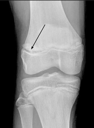 <p>fracture that extends into the epiphyseal plate of a growing bone, potentially affecting growth. </p>