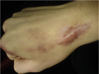 <p><span>raised scar due to collagen overproduction </span></p><p><span>scar remains within the boundaries of the wound</span></p><p></p>