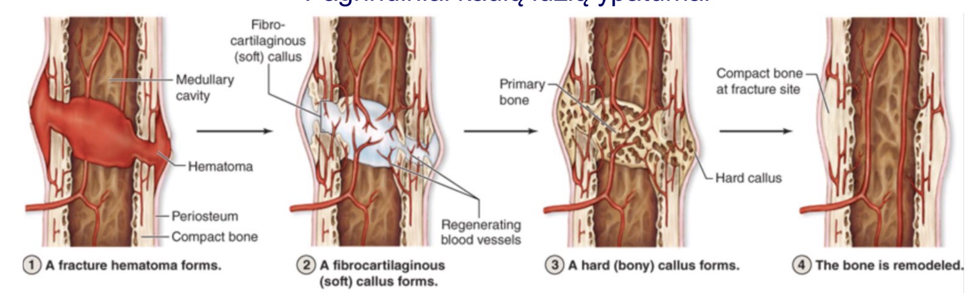 <p>Susiformuoja hematoma → vietoje jos formuojasi skaiduline kremzle, sudarydama minksta rumba → <span>Osteogeninės ląstelės aktyvuojamos <em>antkaulio </em>srityje, virsta osteoblastocitais ir pradeda gaminti kaulinį audinį rumbo paviršiuje. Palaipsniui kremzlė kalcifikuojasi rumbo viduje ir keičiama kaulu (endochondrinis kaulo form.) → Tinklinis skaidulinis kaulinis a. keičiamas plokšteliniu. Kaulas remodeliuojamas</span></p>