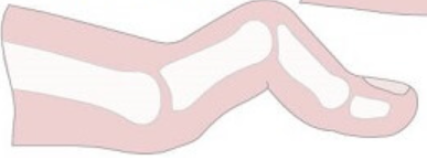 <p>PIP flexion, MTP and DIP hyperextension </p>