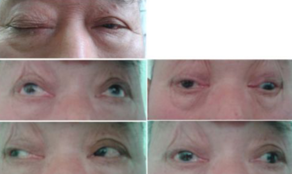 <ul><li><p><strong>Down and out pupils</strong></p></li><li><p>Ptosis</p></li><li><p>Fixed pupil dilation</p></li><li><p>Aneurysm in circle of Willis</p></li><li><p>Commonly caused by diabetes </p></li></ul><p></p>