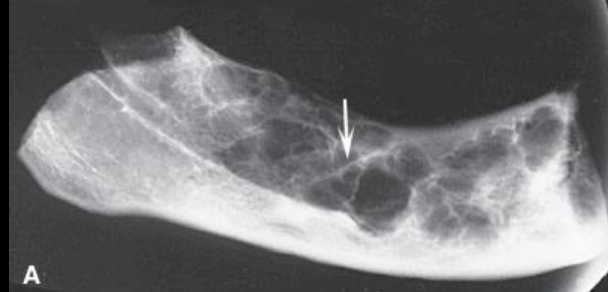 <p>Odontogenic Myxoma</p>