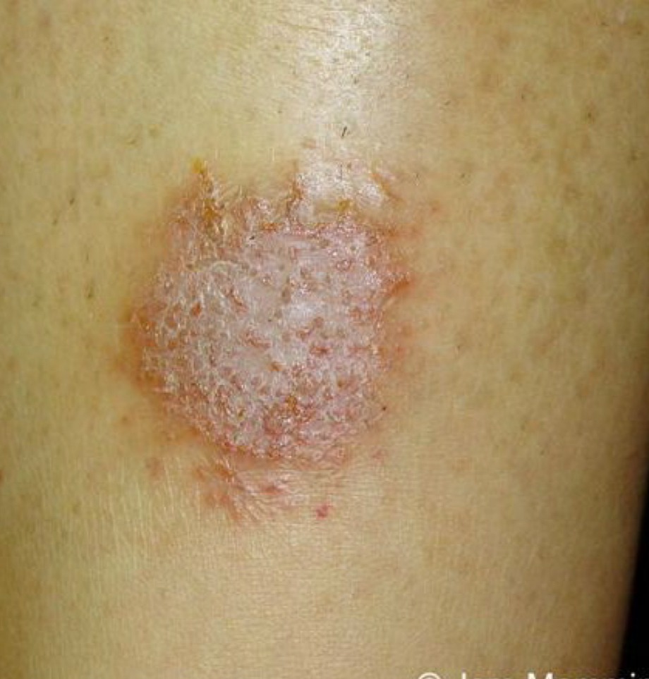 <p>what shape/arrangement and condition is depicted</p>