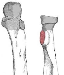 <p>Radial Head + Radial Notch of Ulna</p><p></p><p>Pivot</p><p></p><p>Supination / Pronation</p>