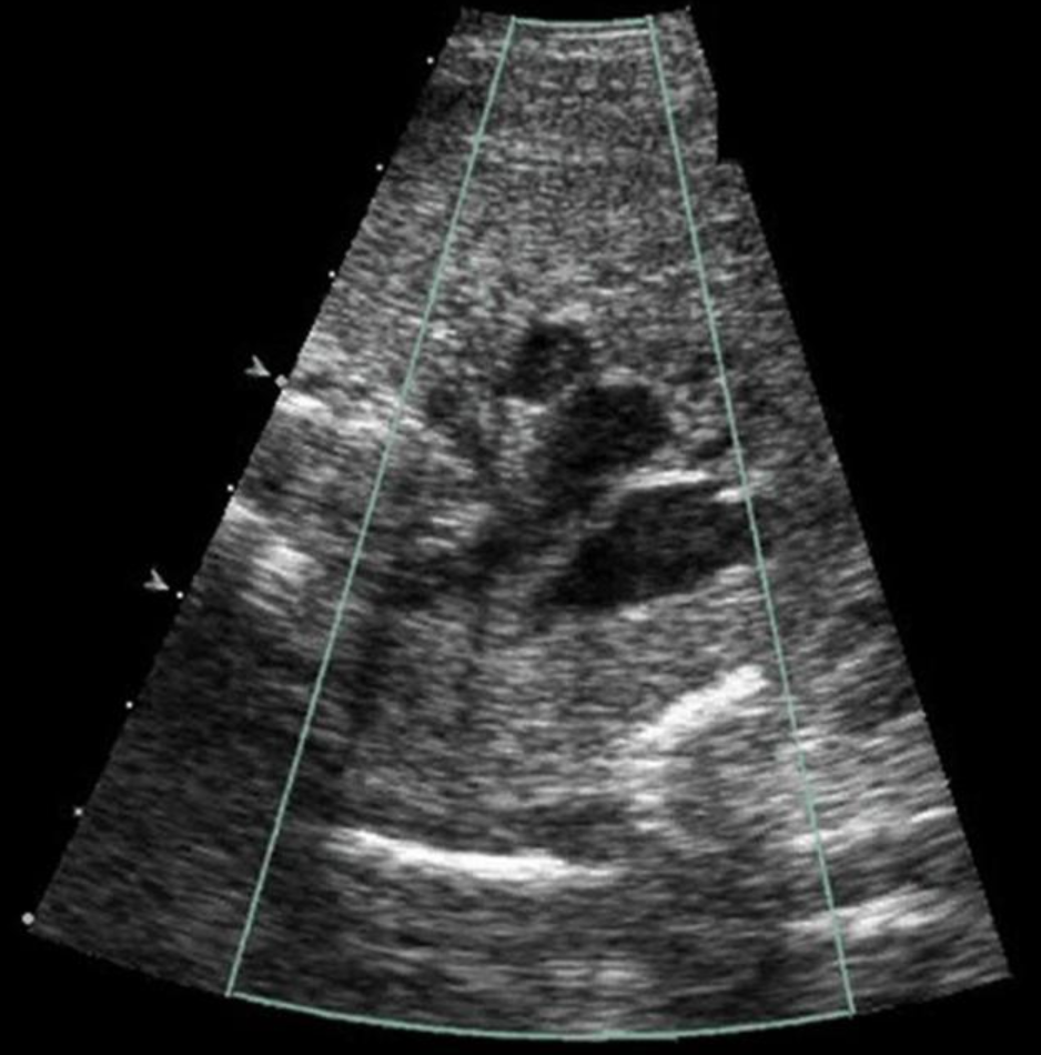 <p>where is the AO in this 3 vessel view - which dot is it</p><p>a) top</p><p>b) middle</p><p>c) bottom</p>