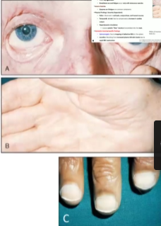 <ul><li><p>Mild to Moderate: often asymptomatic but can have breathlessness (dyspnea) and fatigue upon exercise </p></li><li><p>Severe Anemia: dyspnea and fatigue, pallor in nails, conjunctiva and buccal mucosa, tachycardia at rest</p></li><li><p>Hemolytic Anemia: splenomegaly because too many defective RBC’s accumulate in the spleen, Jaundice</p></li></ul><p></p>