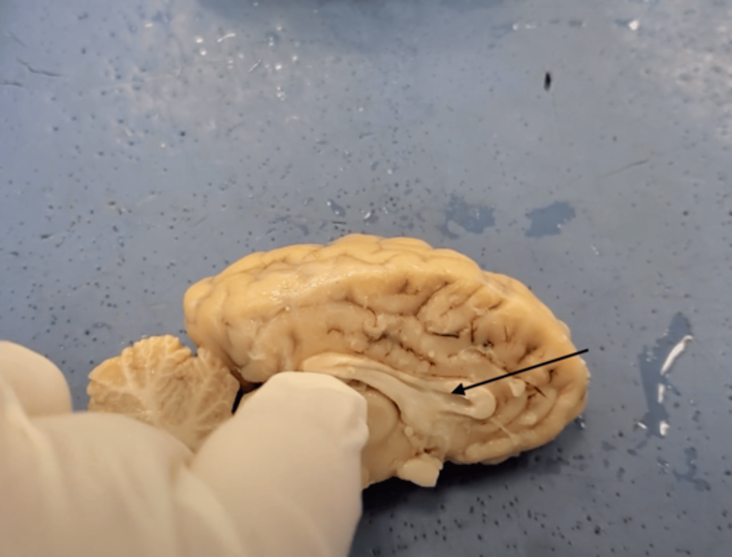<p>the large band of neural fibers connecting the two brain hemispheres and carrying messages between them</p>