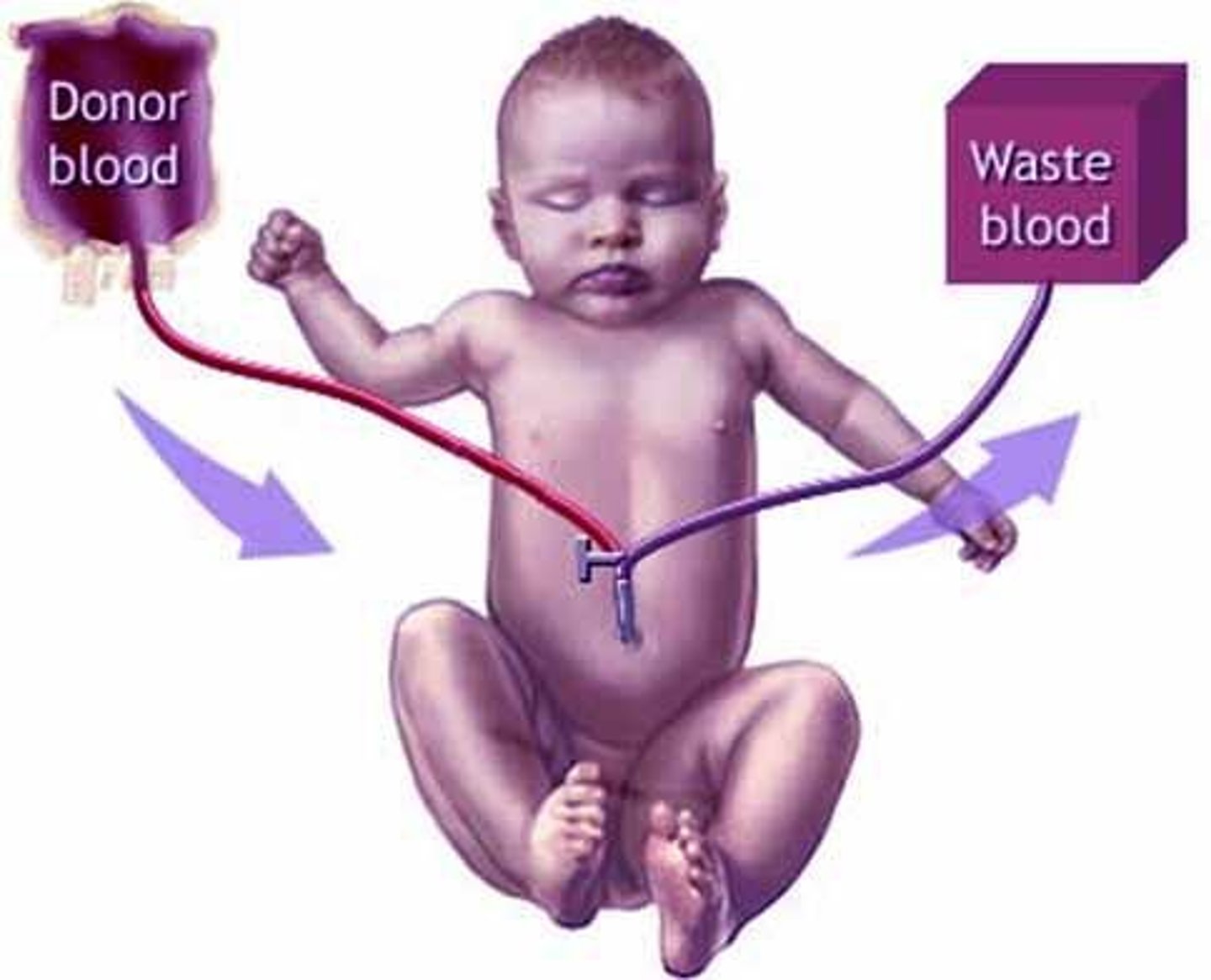 <p>Includes phototherapy and exchange transfusion.</p>