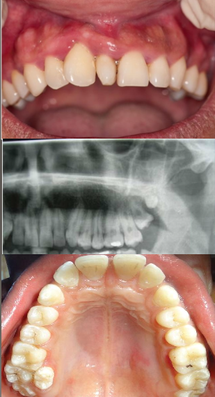 <p>Development of an increased number of teeth, commonly known as supernumerary teeth.</p>