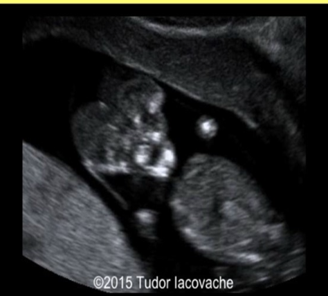 <p>during a fetal head scan of a 16w fetus, the <strong>calvarium</strong> is found to be<strong> absent</strong></p><p>.</p><p><strong>cerebral tissue is there</strong> but has an irregular appearance. this is</p><p>.</p><p>a) dandy walker malformaiton</p><p>b) encephalocele</p><p>c) arhinia</p><p>d) acrania</p>