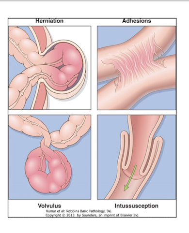 <p>herniation, adhesions, volvulus, intussusception, neoplasm</p>