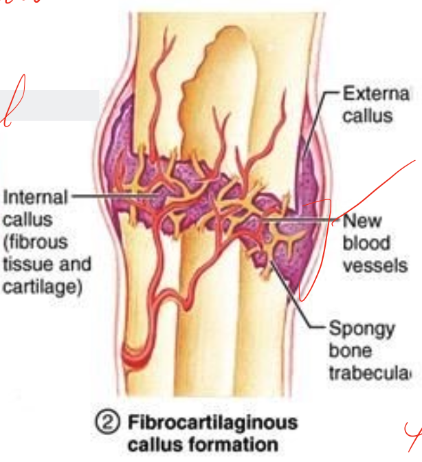 <ul><li><p>2-6 weeks </p></li><li><p>resorption of necrotic bone </p></li><li><p>characterized by differentiation of cells </p></li><li><p>fracture hematoma (invaded by chondroblasts and fibroblasts which lay down the matrix for the callus)</p></li><li><p>early soft callus composed of mainly fibrous tissue and cartilage with a very small amount of bone </p></li><li><p>increased vascularity </p></li></ul><p></p>