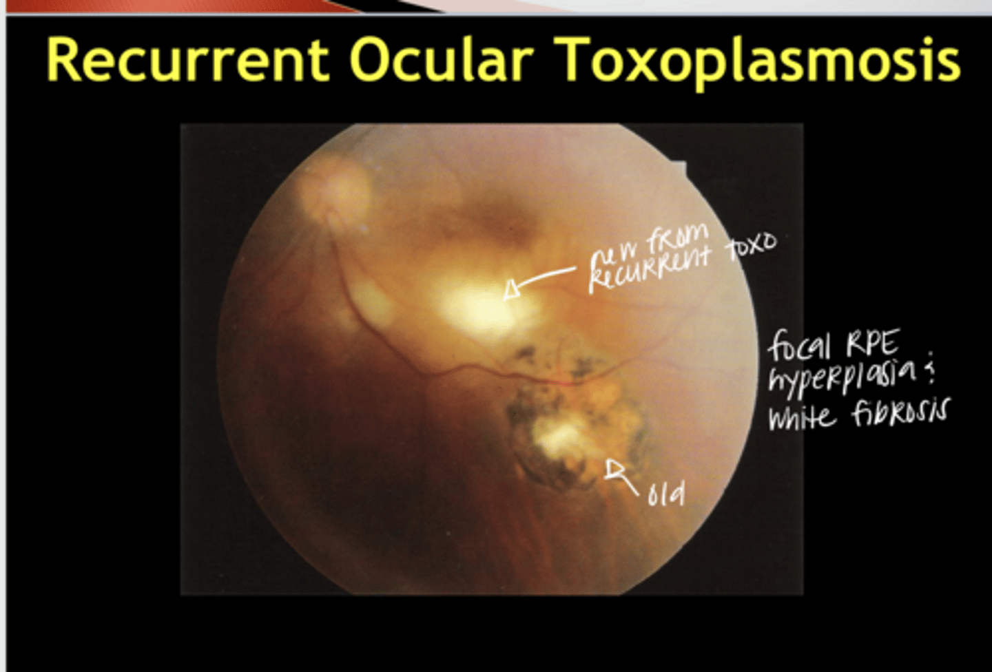 <p>What is the hallmark signs of an OLD Toxoplasmosis lesion in the retina?</p>