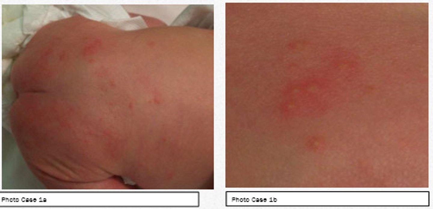 <p>Appears in up to half of newborns carried to term, usually between day 2-5 after birth. Resolves within first two weeks of life, and frequently individual lesions will appear and disappear within minutes or hours. It is a benign condition thought to cause no discomfort to the baby</p>
