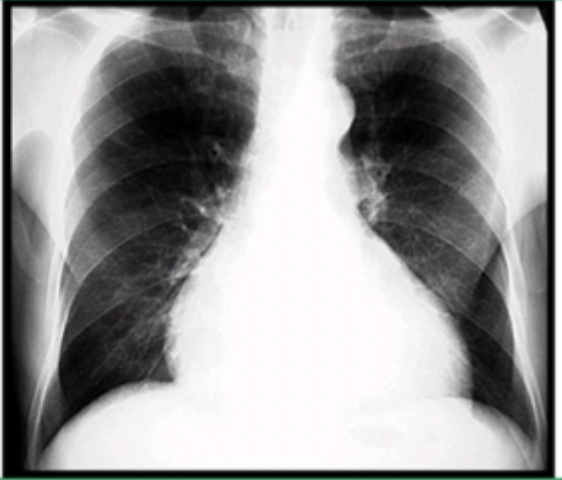 <p>Patient presents to the ER with SOB and fatigue. He states the the SOB is worse when he lays down, especially at night. On a physical exam you note a high pitched holosystolic at the LLSB that radiates to the back and increases with isometric hand grips. You also note an S3, JVD, pulmonary rales, hepatomegaly, and peripheral edema. No hx of travel. What studies do you want to order?</p>