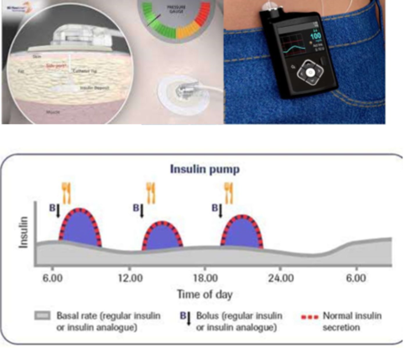 <p>- per carbohydrate content</p><p>- glucose level pre-meal</p><p>- check: glucose levels 1-2 hr post</p>