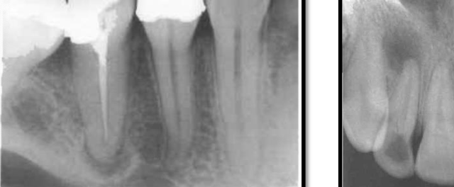 <p>around the tip of the tooth root</p><p>important in endodontic diagnosis</p><p><span style="color: red;"><span>most common</span></span> radiolucency in the jaws</p><p>usually caused by <span style="color: red;"><span>pulpal (nerve) disease</span></span></p><p><strong>recent lesions in periapical:</strong></p><ul><li><p><span style="color: red;"><span>no radiopaque border</span></span></p></li><li><p>grow <span style="color: red;"><span>faster</span></span></p></li></ul><p><strong>long-standing lesions in periapical:</strong></p><ul><li><p>surrounded by a <span style="color: red;"><span>radiopaque (white) line</span></span></p></li><li><p>grow <span style="color: red;"><span>slowly</span></span></p></li></ul><p><em>—radiographs cannot confirm if a lesion is a cyst</em></p>