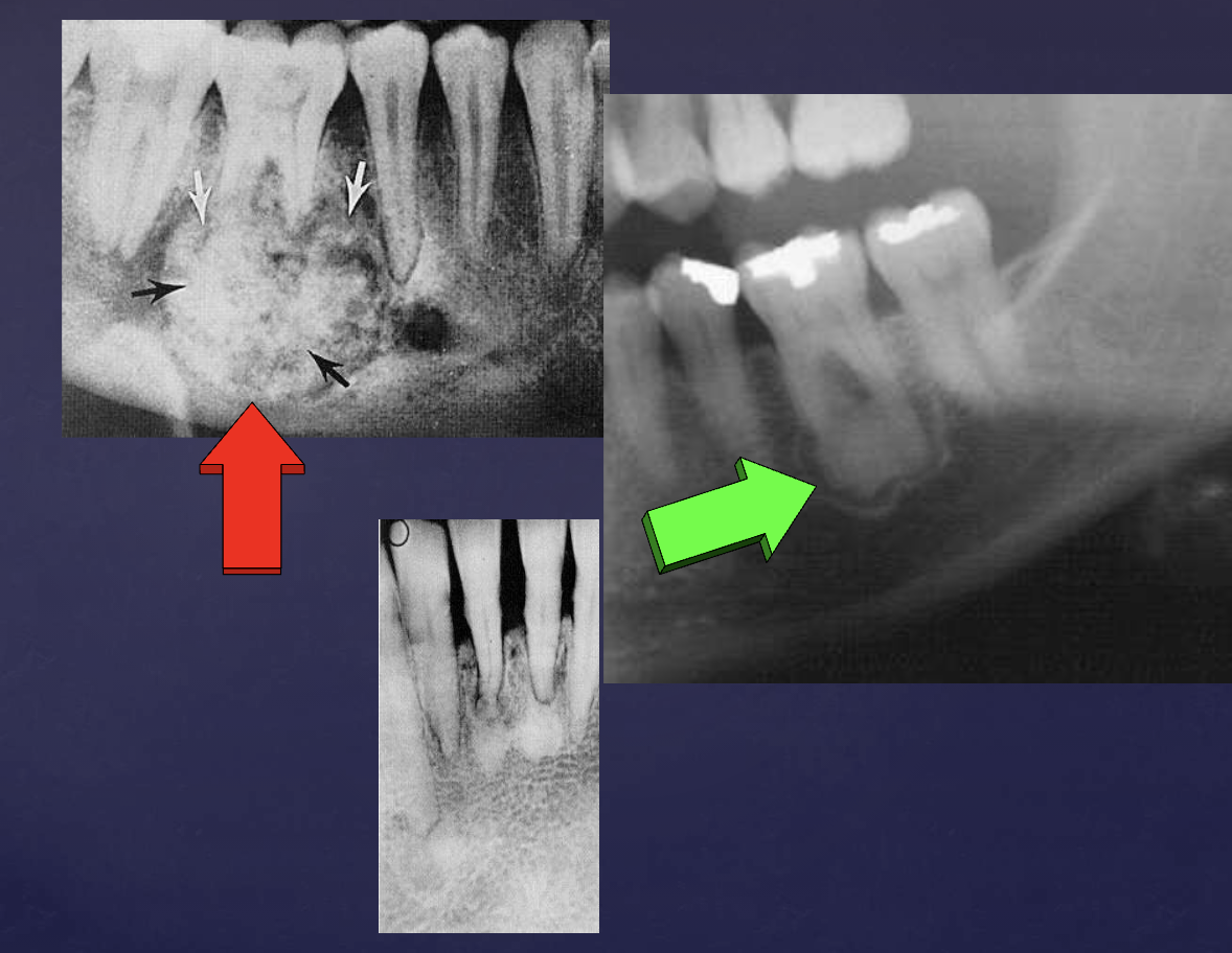 <ol><li><p><strong>multiple punctate radi<u>opacities</u> </strong>within a well-defined radiolucency</p></li><li><p>homogeneous radiopaque mass</p></li><li><p>mass attached to 1st mandibular molar roots</p></li><li><p>obscured root outline, external resorption</p></li><li><p><strong>radio<u>lucent</u> halo </strong>- <strong>continuity w/ PDL</strong></p></li><li><p>sclerotic border</p></li></ol><p></p>