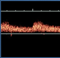 <p>what type of resistance waveform does this show (arterial)? </p>