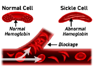 <p>The Risk is Sickle Cell Crisis:</p><p>Acute Chest Syndrome (ACS)</p><p>Chronic pain</p><p>Organ Damage</p><p>Swelling in hands &amp; feet</p><p>Bacterial infections</p><p>Autosplenectomy (repeated splenic infarctions from sickled RBCs eventually lead to fibrosis and shrinkage of the spleen)</p>