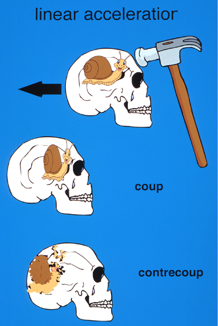 <p>What type of injury occurs at the site of impact during a head trauma caused by linear acceleration?</p>