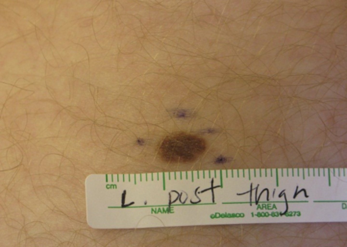 <p>A flat, non-palpable lesion less than 1.0 cm in size</p>
