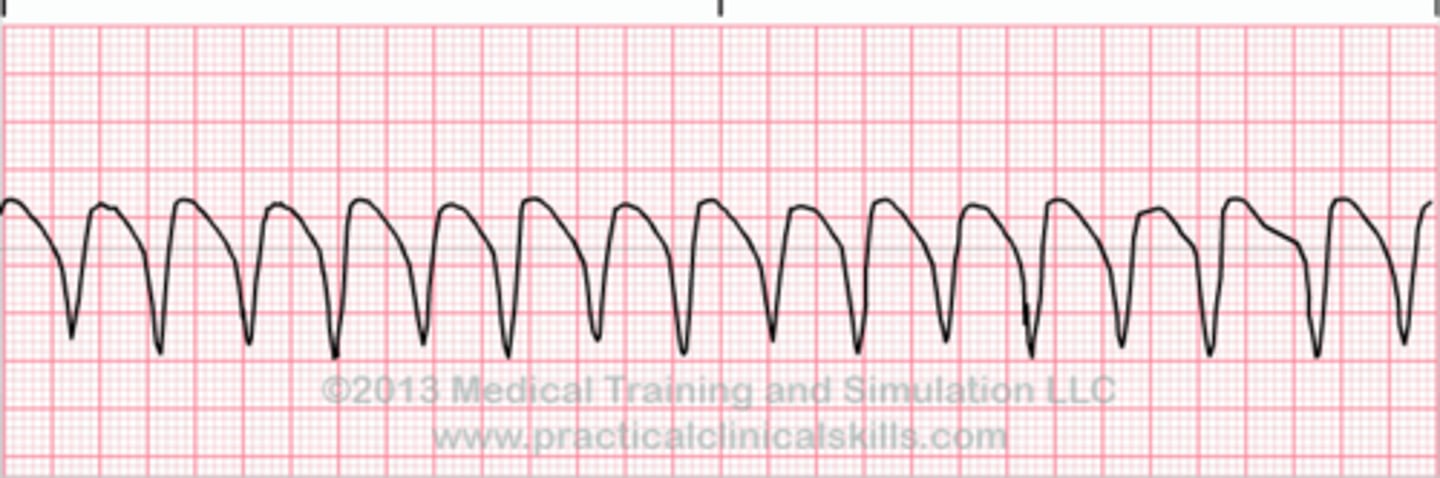 <p>tombstones, 3 PVC in a row</p><p>-can be pulseless or pulse</p><p>-asses for pulse first</p>