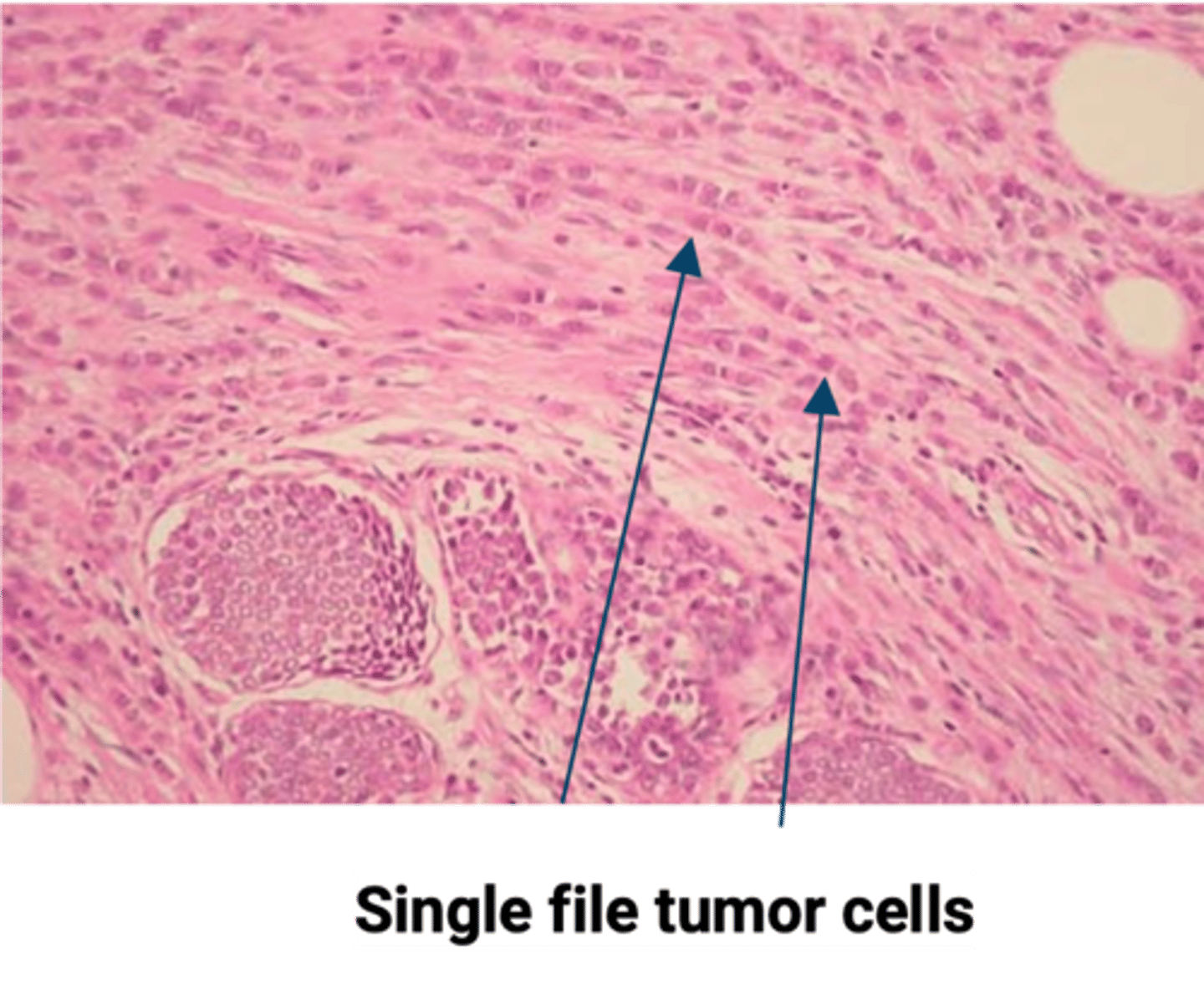 <p>Define Type of Breast Cancer:</p><p>-Path: Biallelic loss of CDH1 (E-cadherin)</p><p>cell layer</p><p>-Dx: Histo: Dyscohesive invading tumor cells in a “single file” and no duct formation; No desmoplastic response</p>
