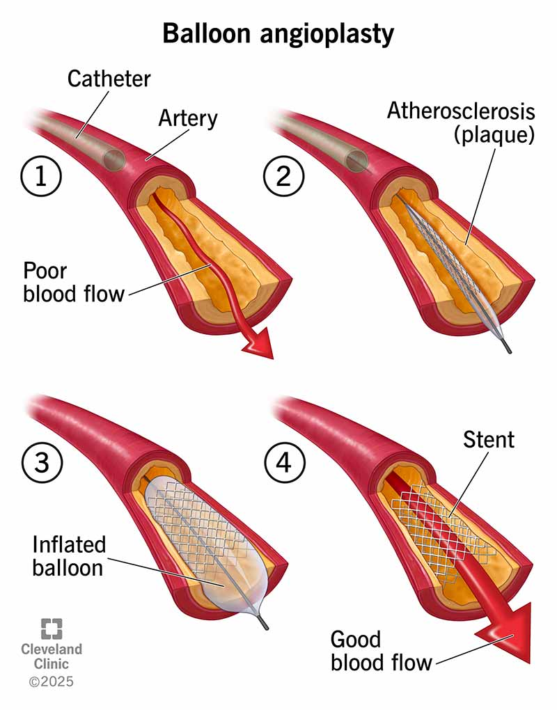 <p>What is an Angioplasty?</p>