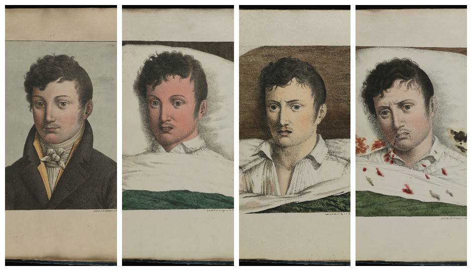 <p>19th century illustrations showing stages of Yellow Fever</p>