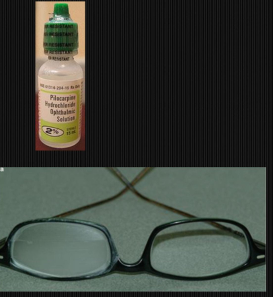 <p>eserine or pilocarpine to stimulate the CB mm (but side effects of CB spasm, HA, myopia)</p><p>OR</p><p>MF CL in affected eye</p><p>OR</p><p>occlude/frost bottom part of glasses lens to prevent binocular vision at near (induce monovision)</p>