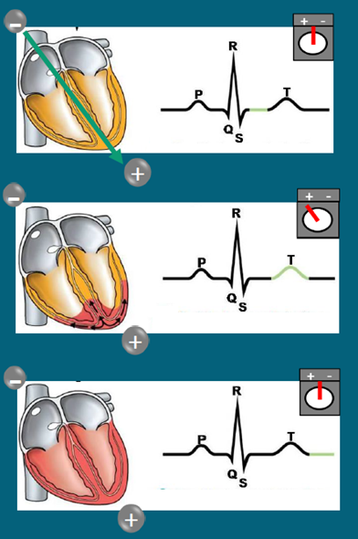 <p>Ventricular repolarisation</p><p>Direction of <strong>repolarisation </strong>is <strong>away </strong>from electrode of lead II so positive deflection </p><p>Starts at apex, epicardium, endocardium </p>