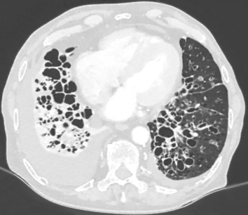 <p>Air trapping and hyperinflation</p><p>Bronchiectasis</p>