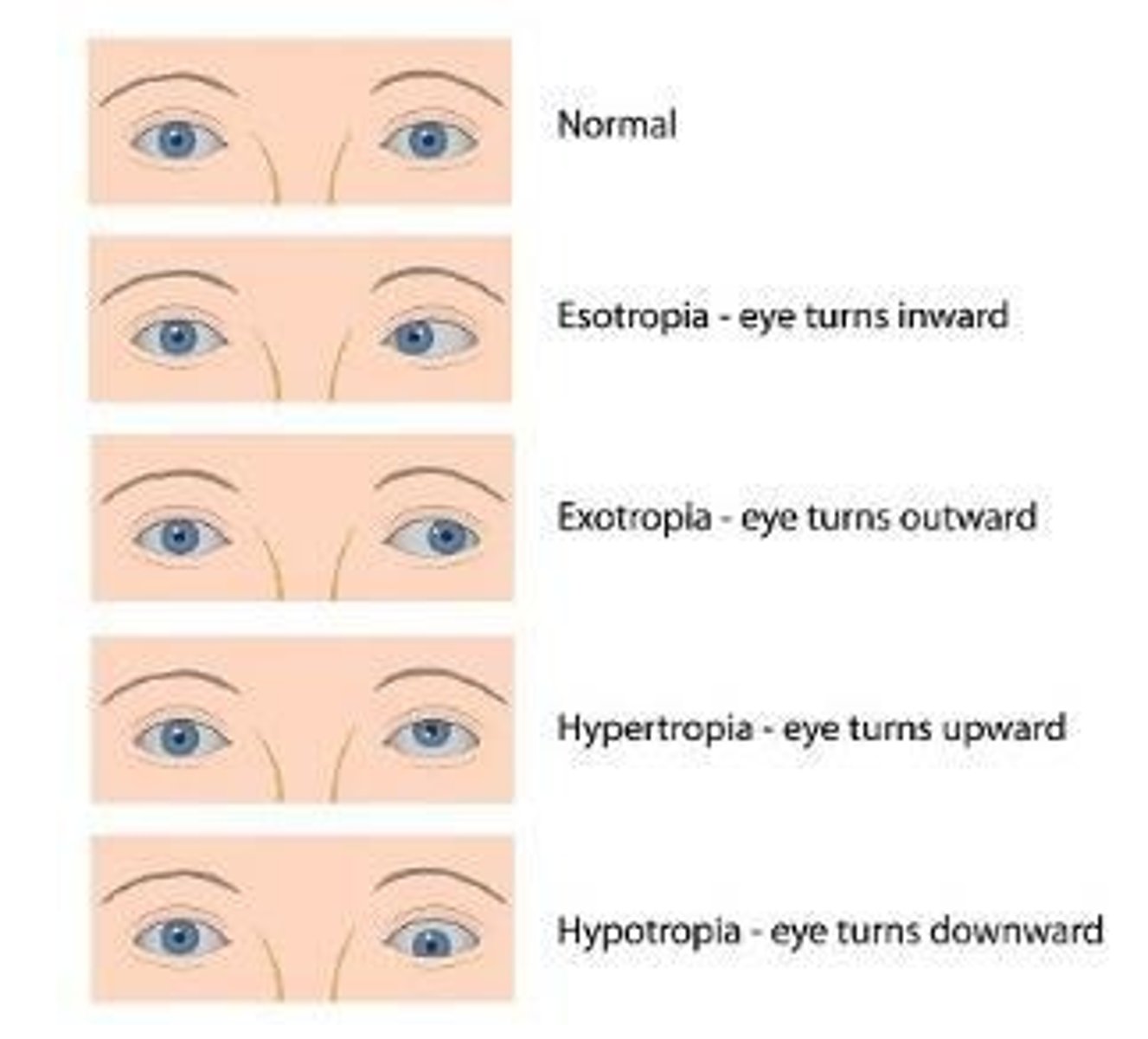 <p>Strabismus is misalignment of the eyes, with manifestations including abnormal corneal light reflex, misaligned eyes, squinting, head tilting, headaches, and photophobia.</p>