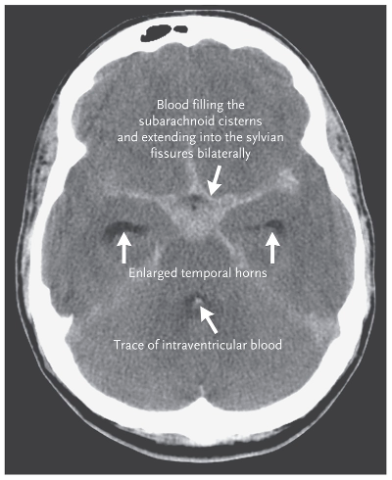 <ul><li><p>sudden bleeding into the subarachnoid space (csf mixes with blood)</p></li><li><p>Symptoms include sudden, severe headache, usually with loss or impairment of consciousness.</p></li><li><p>frequently a sign of a ruptured aneurysm </p></li></ul><p></p>
