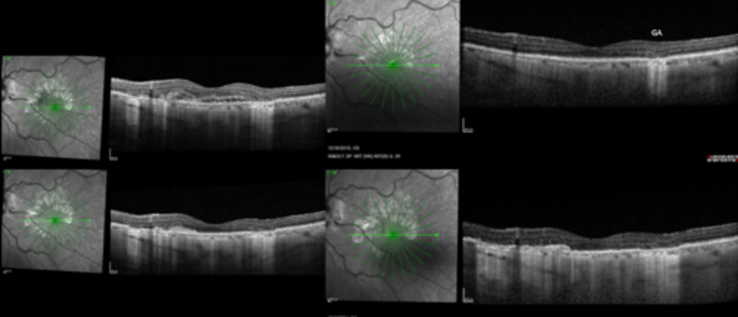 <p>True or False: anti-VEGF does not treat AMD.</p>