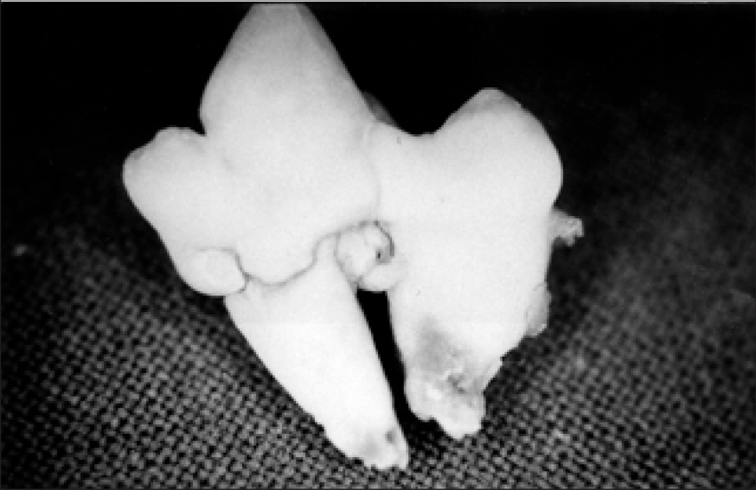 Small nodules of enamel found on the root surface, often at the neck of the tooth.