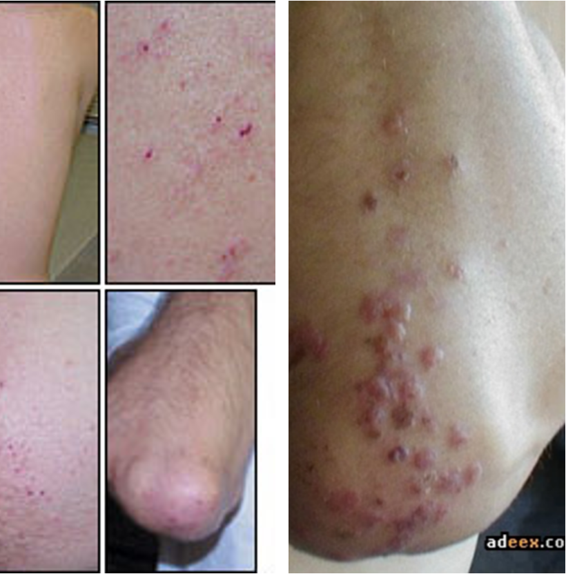<p>The intensely pruritic papulovesicular rash over extensor surfaces, trunk, scalp, and neck known as <strong>dermatitis herpetiformis</strong> is a characteristic rash of what condition?</p>