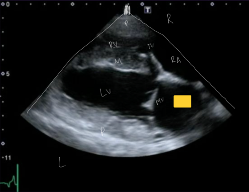 <p>Right Parasternal Long Axis View</p><p></p>