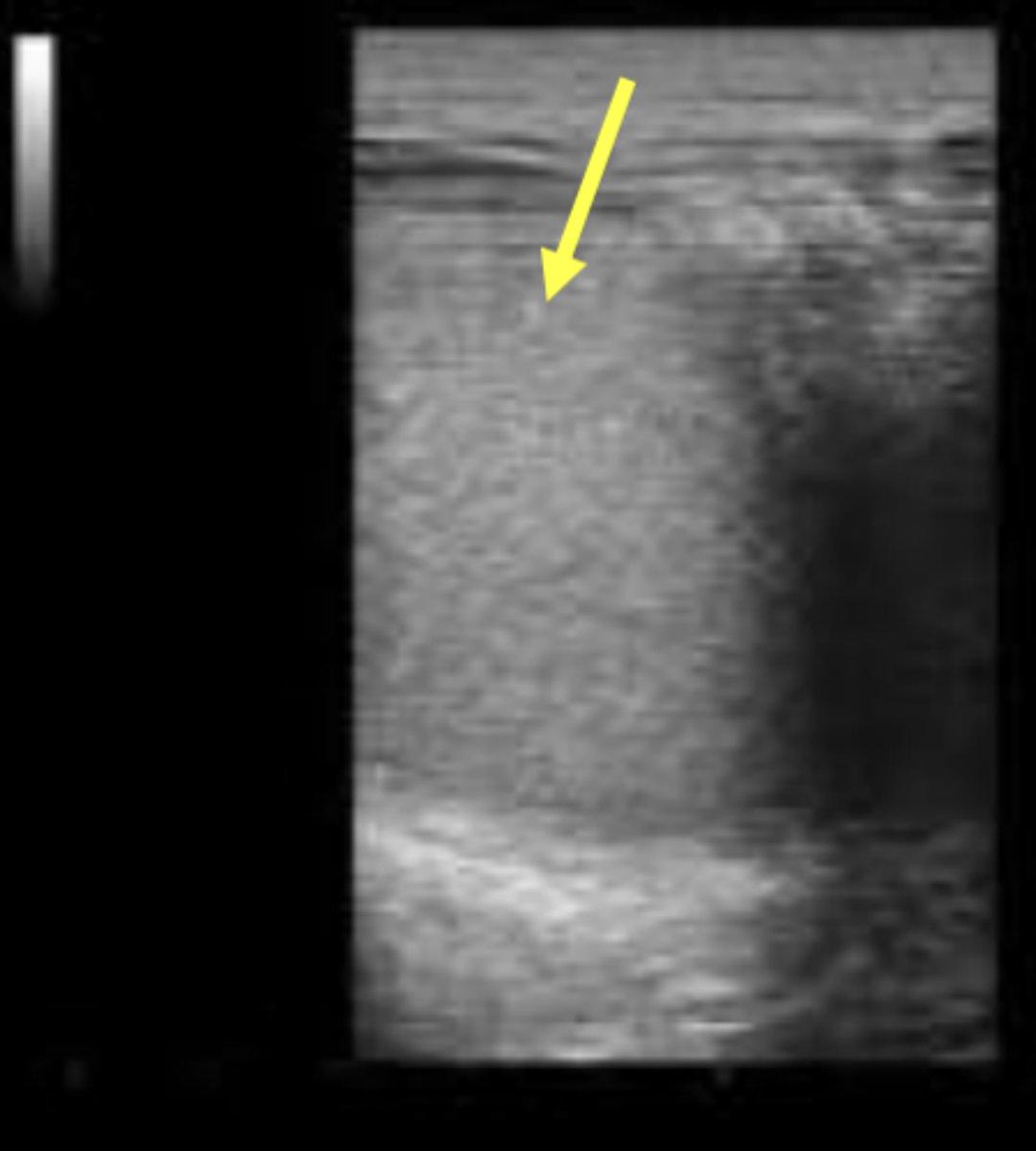 <p>Transrectal ultrasonography of a cow with history of anestrus reveals presence of a corpus luteum on the right ovary, small follicles on the left ovary, and the uterus appears as shown in the picture. What clinical condition are we most likely dealing with?</p>