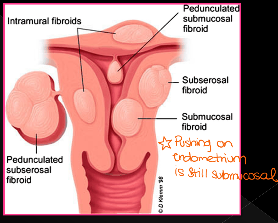<p>Leiomyomas can be described as three types, what are they?</p>