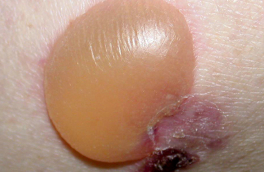 <p>A fluid filled sac that is GREATER than 1 cm</p>