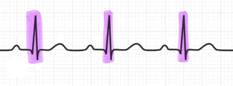 <p><strong><em>(Note: Explain what is happening during each)</em></strong></p><p><span>the sharp downward, upward, downward spike is called the </span><strong>QRS complex</strong></p><ul><li><p><span>the atria are repolarizing and relaxing. During the end of the QRS complex, the ventricles are depolarizing and contracting</span></p></li></ul><p></p>