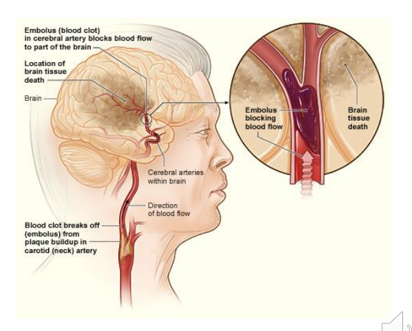 <p>Ischaemic Stroke</p>